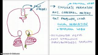 Easy Ways to Remember Cerebral Herniation [upl. by Leamse530]