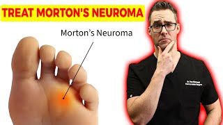 How To Treat Mortons Neuroma amp Foot Injection Research [upl. by Colyer]