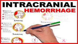 Hemorrhagic Stroke  Intracerebral Hemorrhage amp Subarachnoid Hemorrhage  Management [upl. by Eidassac]