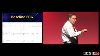 ECG Mini MasterClass Subtle ACS [upl. by Cori]