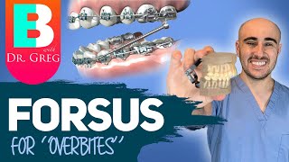 Braces Forsus for Overbite Overjet Correction [upl. by Cerf73]