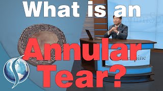 What Is An Annular Tear [upl. by Enitsrik]