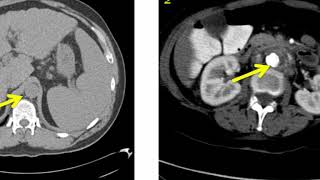 Introduction to Radiology Computed Tomography [upl. by Auqcinahs71]