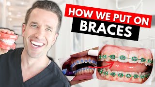 How Braces are Put On  Part IV Dr Nate [upl. by Cicero]