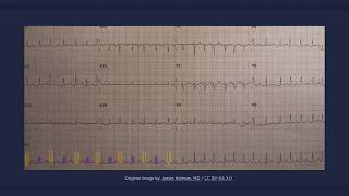 Electrical Alternans ECG [upl. by Clarinda414]