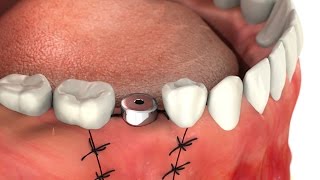 SIC invent Dental Implant Guideline for patients Abutment Single Tooth [upl. by Barby661]