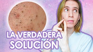 PUNTOS NEGROS Como tratar y prevenir los comedones abiertos  Recomendaciones de un dermatologo [upl. by Apoor]