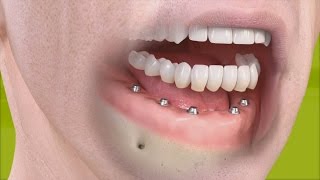 Straumann  Fixed restoration with 46 implants all straight [upl. by Kato]