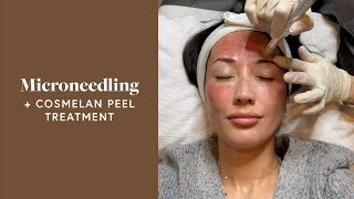 Microneedling Treatment amp Cosmelan Peel For My Melasma  Susan Yara [upl. by Akins888]