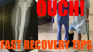 How to Recover Quickly From Broken Leg Fractured Tibia  Fibula ORIF Surgery [upl. by Otrebcire]