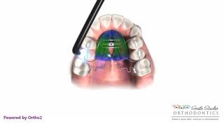 Pendex  Orthodontic Appliance [upl. by Trager]