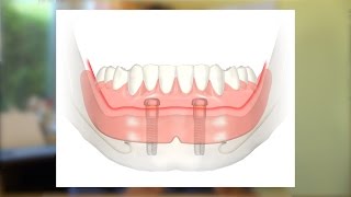 Eine kostengünstige Implantatlösung [upl. by Nasas941]