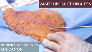 The Science Behind Vaser Liposuction How Does It Work [upl. by Shue]