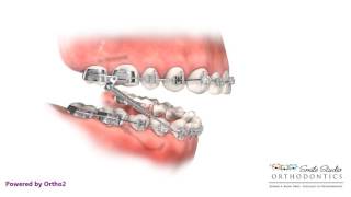 Headgear VS Forsus  Orthodontic Treatment [upl. by Web]