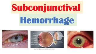 Subconjunctival Hemorrhage  Broken blood vessel on eye  Causes amp Treatment [upl. by Kciredec991]