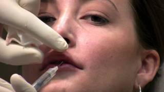 Juvederm Ultra filler injection to lips for lip augmentation in Virginia [upl. by Idnam]