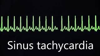 Cardiovascular System 8 Normal and abnormal heart rhythms [upl. by Cummine]