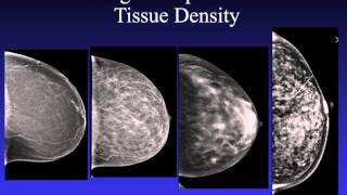 Introduction to Mammography [upl. by Linker]