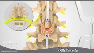 Minimally Invasive Spine Surgery ILIF Interlaminar Lumbar Fusion in Sparks Reno Carson [upl. by Oijile181]