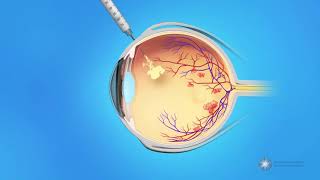 Intracranial Haemorrhage in 2 minutes [upl. by Anilram]