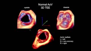 3D Echocardiography Acquisition Cropping and Case Examples [upl. by Eilyr562]