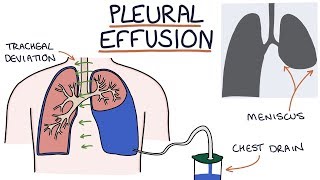 Understanding Pleural Effusions [upl. by Mcclimans]