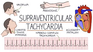 Understanding Supraventricular Tachycardia SVT [upl. by Adnarim493]