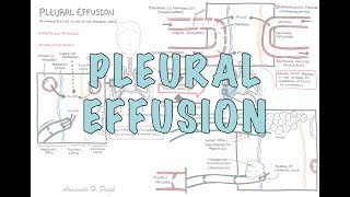 Pleural Effusion DETAILED  pathophysiology signs and symptoms treatment [upl. by Shelby]