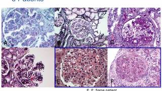 Rapidly Progressive Glomerulonephritis Pathology RPGN Pathology [upl. by Eyahsal]