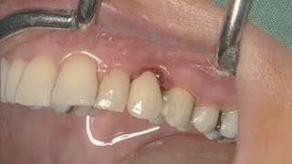 NobelActive clinical case immediate implant placement  Eric Rompen [upl. by Yrogerg]