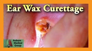 Ear Wax Removal of a Full Ear  Auburn Medical Group [upl. by Nwahsad427]