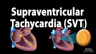 Supraventricular Tachycardia SVT PSVT Animation [upl. by Osy]