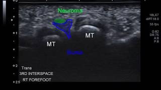 mortons neuroma bursal complex [upl. by Sherourd]