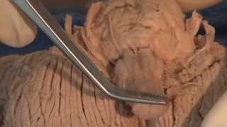 Cranial Nerves Neuroanatomy Video Lab  Brain Dissections [upl. by Pollock41]