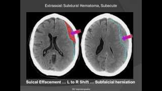 Subdural Hematoma SDH [upl. by Khorma822]