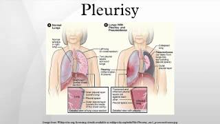 Pleurisy [upl. by Hgieleak700]