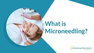 What is Microneedling  Microneedling Treatment [upl. by Kitty]