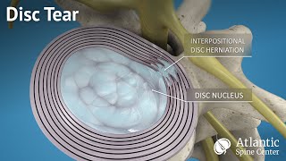 Disc Tear [upl. by Marijn]