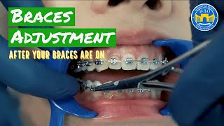 How Do Braces Straighten Teeth [upl. by Nwotna]