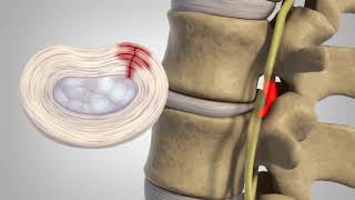 Herniated Disc  Patient Education [upl. by Festatus]