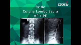 Radiografia da Coluna Lombo Sacra AP  Perfil  Ortostática [upl. by Carmelina]