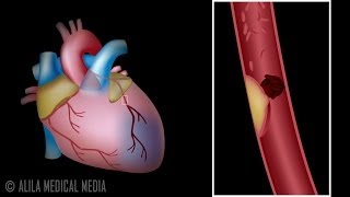 Myocardial Infarction and Coronary Angioplasty Treatment Animation [upl. by Ikkir991]