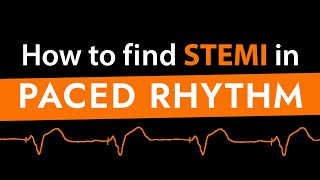 How to find STEMI in Paced Rhythm feat Dr Sgarbossa [upl. by Drape356]