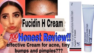 Fucidin H Cream 100 Honest Review amp Uses  Say no to Tiny Bumps  Acne and Pimples  Myra Sharma [upl. by Arvad]