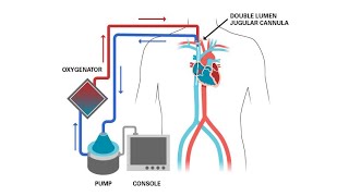 RealLife ECMO Cases [upl. by Ahsirak]