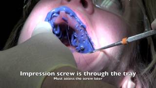 Dental Implant  Impression and Insertion of crown [upl. by Anelleh741]