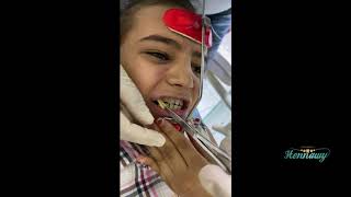 orthodontic facemask installation [upl. by Elman894]