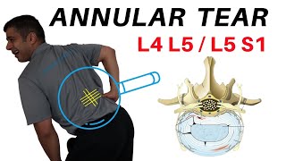 Annular Tear L4L5 L5S1 Disc Bulges [upl. by Fulbright]