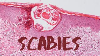 What is Scabies  Pathology mini tutorial [upl. by Franck858]