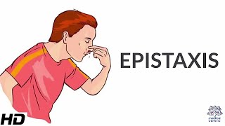 What Causes Epistaxis How to Treat It At Home [upl. by Darelle]